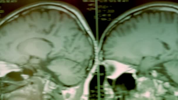 MRI scan of the head. First-person view. The picture shows a large cyst and bone defect. — Stock Video