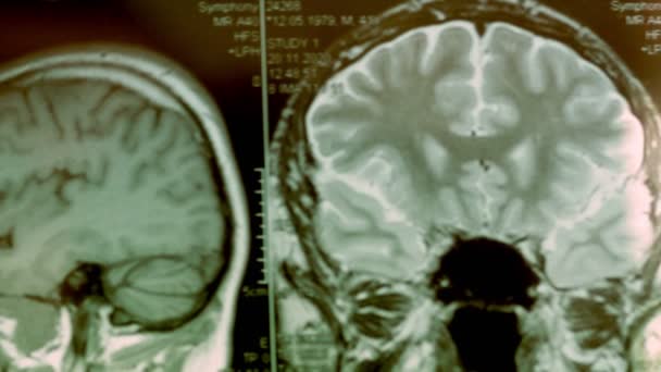 Ressonância magnética da cabeça. Vista em primeira pessoa. A imagem mostra um grande cisto e defeito ósseo. — Vídeo de Stock