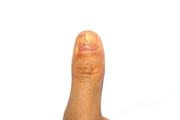 Close-up of a womans right thumb, with a torn or peeling nail. A broken or detached toenail. A toenail is falling off — Stock Photo, Image