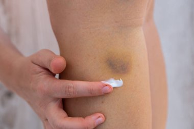 Tanınmayan bir kadın bacağındaki çürükler için tedavi kremi sürüyor. Bacağındaki leke yarasını kapat. Spor aktivitesi travmasının hematom kan sonuçlarının iyileşmesi. Ekstradan mavi mor