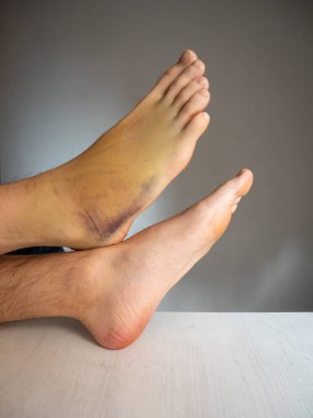 Sağ ayak çürüğü, ayrıca Mor, Sarı ve Yeşil Renkli Geniş Alanda Çürük olarak da bilinir. Cilt Dokularına İç Kanama Sebebi