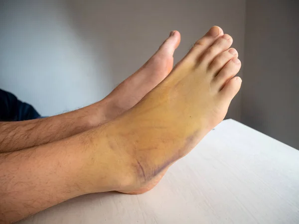 Right Foot Bruise, also known as Contusion on a Large Area with Purple, Yellow and Green Colors Cause by Internal Bleeding into Skin Tissues