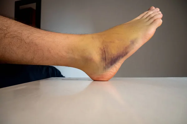 Contusion Pied Droit Également Connue Sous Nom Contusion Sur Une — Photo