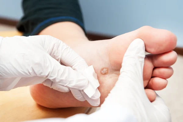 5 152 Wart Stock Photos Free Royalty Free Wart Images Depositphotos