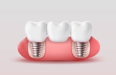Diş köprüsü iki implantla destekleniyor. Sakız, kemik ve sağlıklı dişlerin gerçekçi bir 3 boyutlu çizimi. Vektör illüstrasyonu.