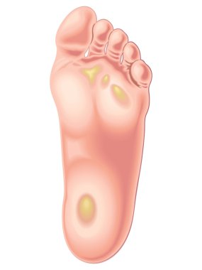 illustration of the position of calluses on the feet clipart