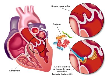 illustration of the symptoms of bacterial endocarditis. clipart