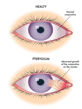 illustration of the symptoms of pterygium. clipart