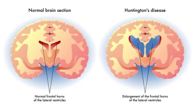 Huntington hastalığı beyinde belirtileri
