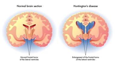 symptoms of Huntington's disease in the brain clipart