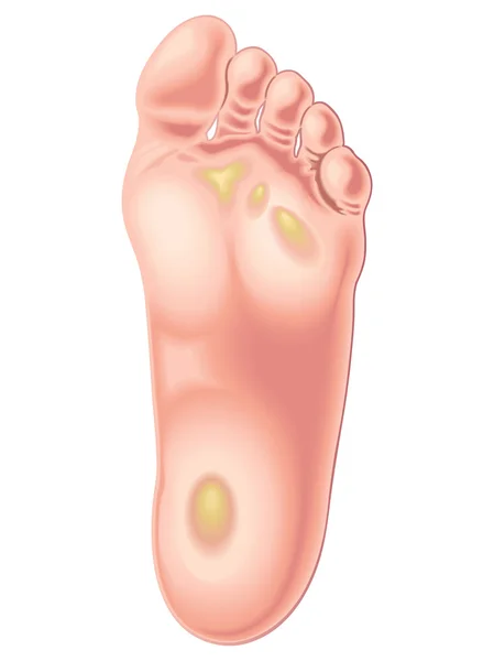 Illustrazione della posizione dei calli sui piedi — Vettoriale Stock