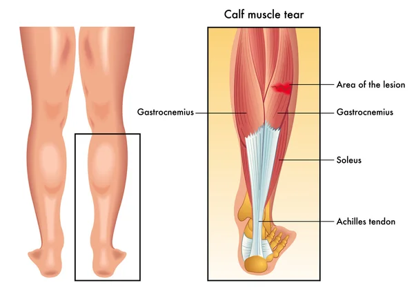 Illustration of the symptoms of calf muscle tear — Stock Vector