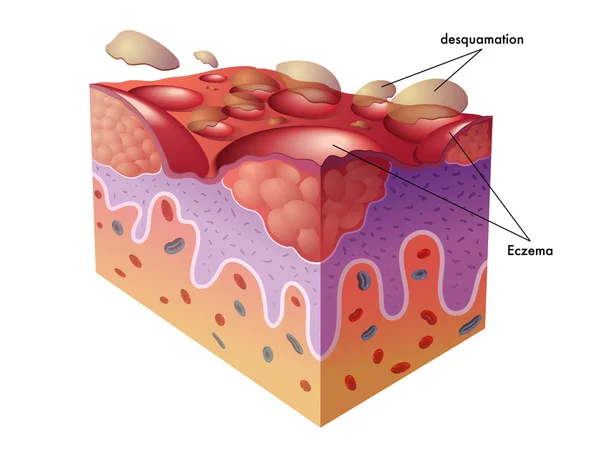 Illustrazione dei sintomi dell'eczema . — Vettoriale Stock