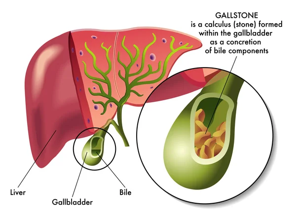 Illustrazione della sezione della cistifellea con calcoli biliari . — Vettoriale Stock