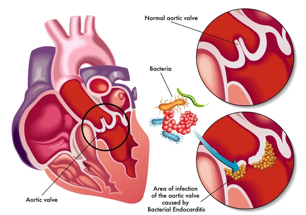 Ilustración de los síntomas de la endocarditis bacteriana . — Vector de stock