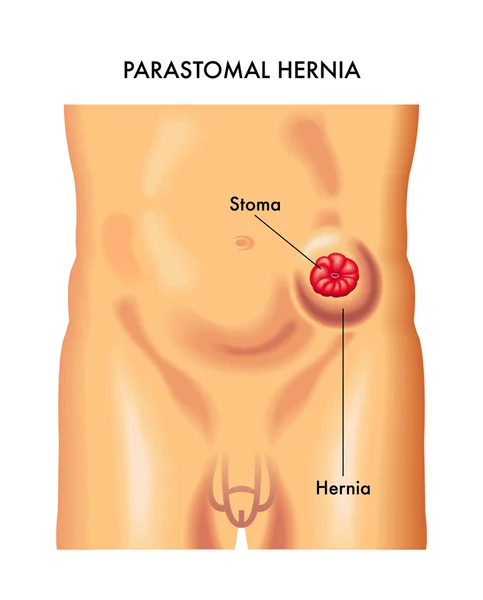 Ilustração dos sintomas da hérnia parastomal — Vetor de Stock