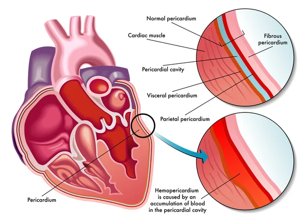 Ilustración de los síntomas del hemopericardio . — Vector de stock