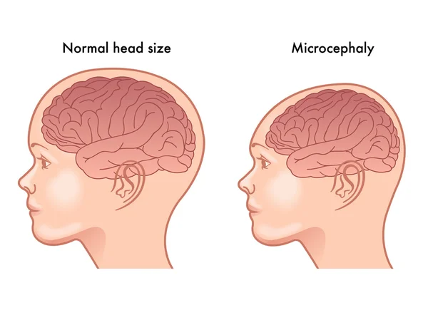 Illustration of the symptoms of microcephaly — Stock Vector