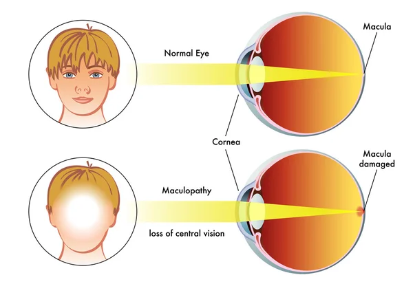 Illustratie van de symptomen van maculopathy — Stockvector