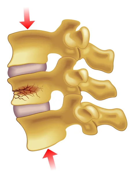 Sintomas de fratura por compressão vertebral — Vetor de Stock