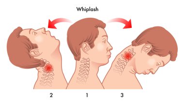 Whiplash yaralanma dinamikleri tıbbi çizimi.