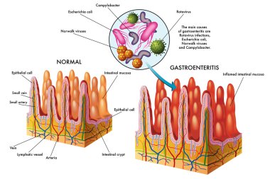Ana nedenleri gastroenterit tıbbi illüstrasyon