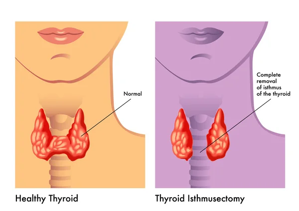 Ilustración médica simple de una operación de istmusectomía tiroidea — Vector de stock