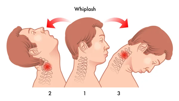 Medical illustration of the dynamics of the whiplash injury. — Stock Vector