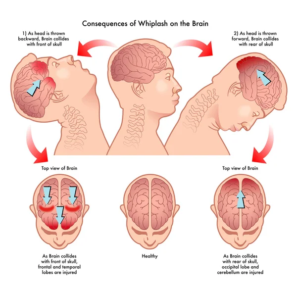 Illustrazione medica delle conseguenze del colpo di frusta sul cervello — Vettoriale Stock