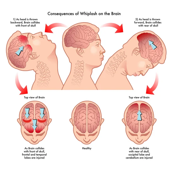 脳にむち打ち症の結果の医療イラスト — ストックベクタ