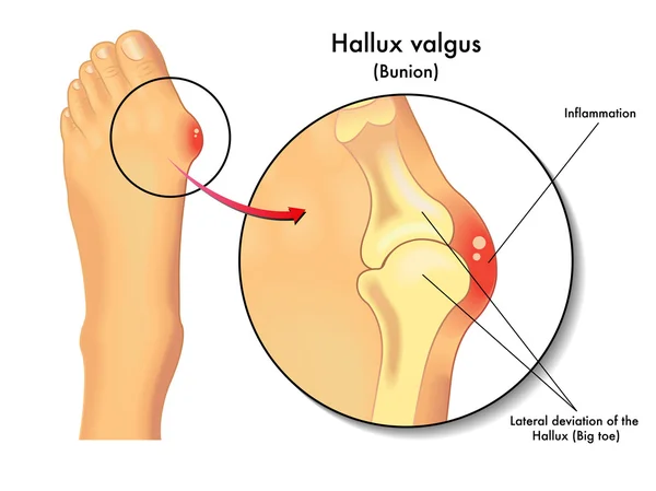 Hallux Valgus. Deformidad Valgus dedo del pie — Archivo Imágenes Vectoriales
