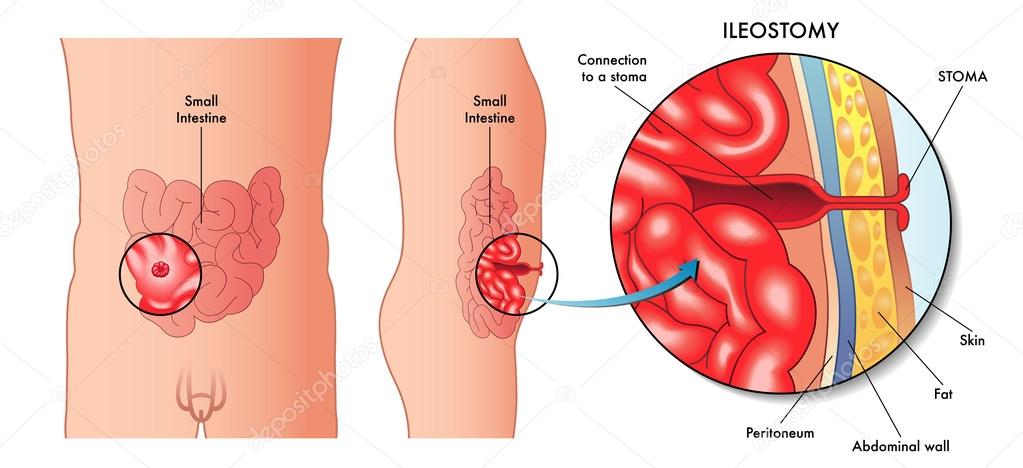 Prosztate resection művelet