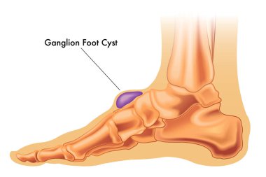 Ayağında notla birlikte bir ganglion kisti tasviri