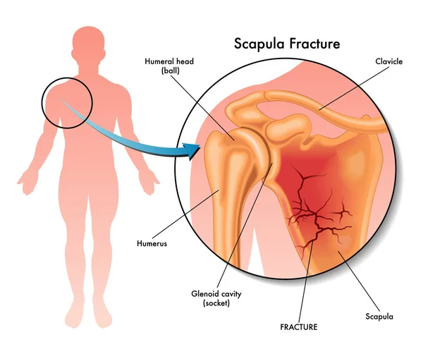 Ilustración Médica Una Fractura Escápula Localización Cuerpo Humano Con Anotaciones — Vector de stock