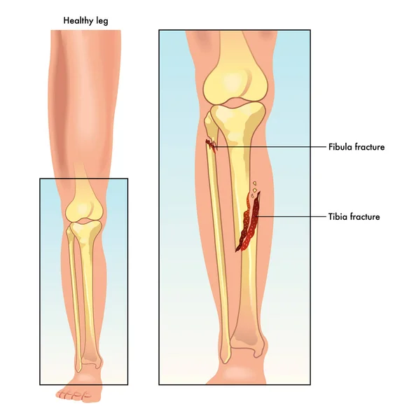 Lékařská Ilustrace Porovnávající Zdravou Nohu Zlomenou Holenní Lýtkovou Kostí — Stockový vektor