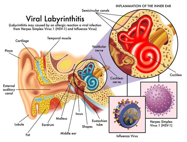 Lékařské Ilustrace Ukazující Zánět Vnitřního Ucha Virové Labyrintitidy Způsobené Herpes — Stockový vektor