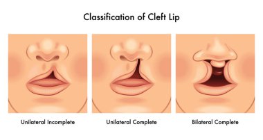 Medical illustration showing cleft lip. clipart