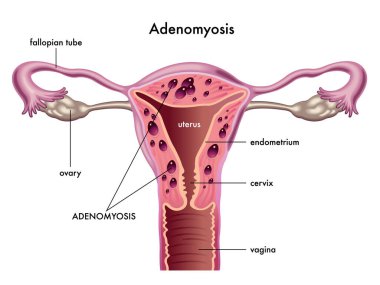 Adenomiyozis gösteren tıbbi çizimler