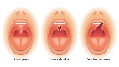 Medical illustration showing cleft palate clipart