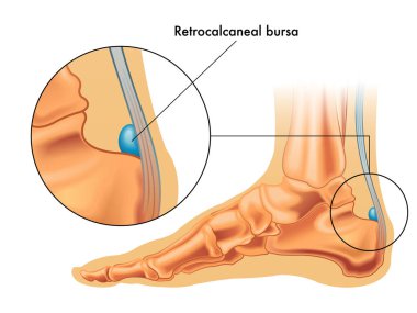 Medical illustration showing retrocalcaneal bursa clipart