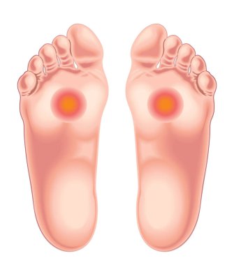 Metatarsaljiyi gösteren tıbbi illüstrasyon