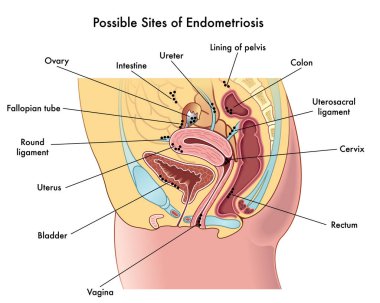 Endometriyozisin olası bölgelerini gösteren tıbbi çizimler