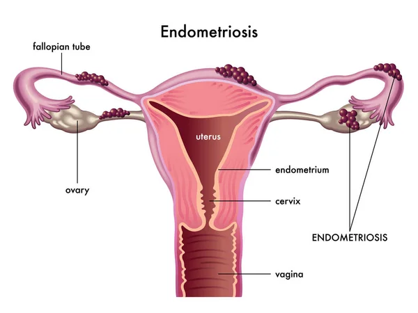 Ιατρική Απεικόνιση Που Δείχνει Ενδομητρίωση — Διανυσματικό Αρχείο