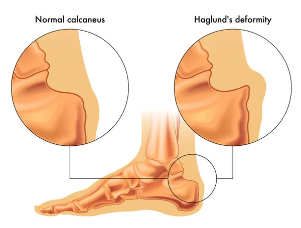 Illustrazione Medica Che Mostra Deformità Haglund — Vettoriale Stock
