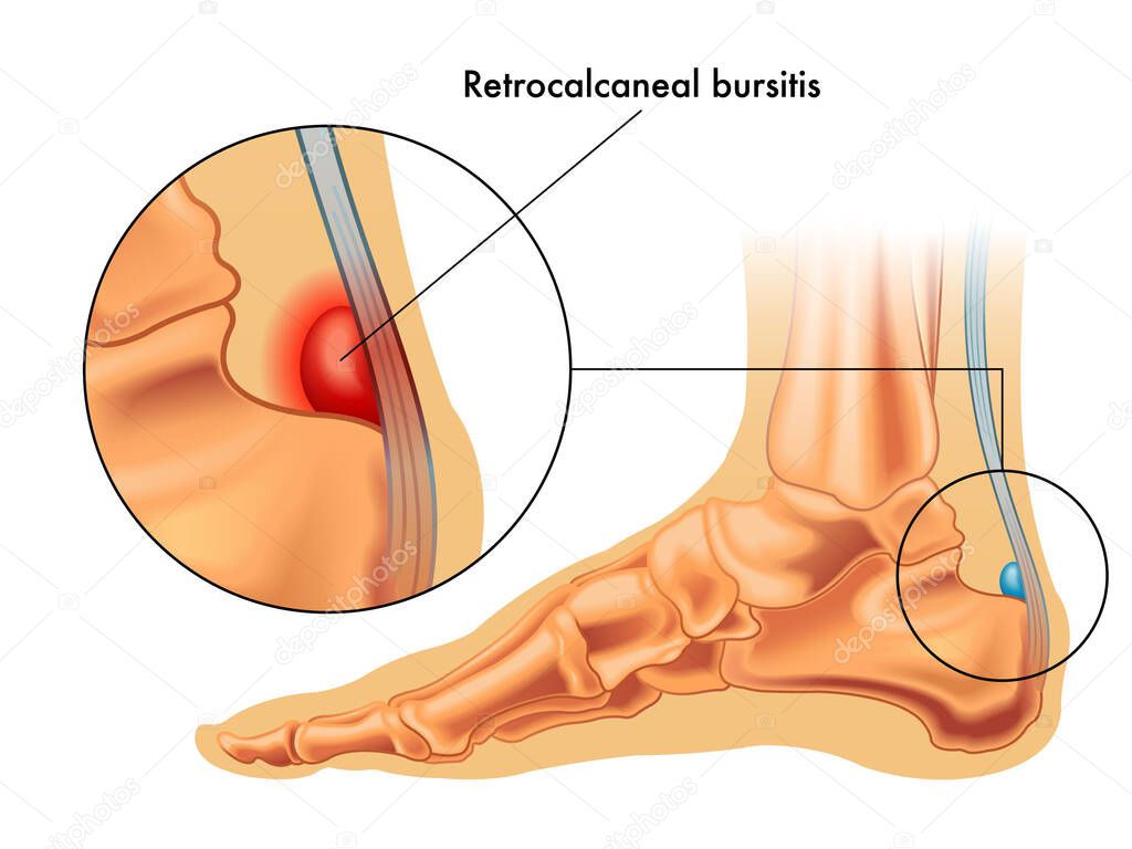 Medical illustration showing retrocalcaneal bursitis