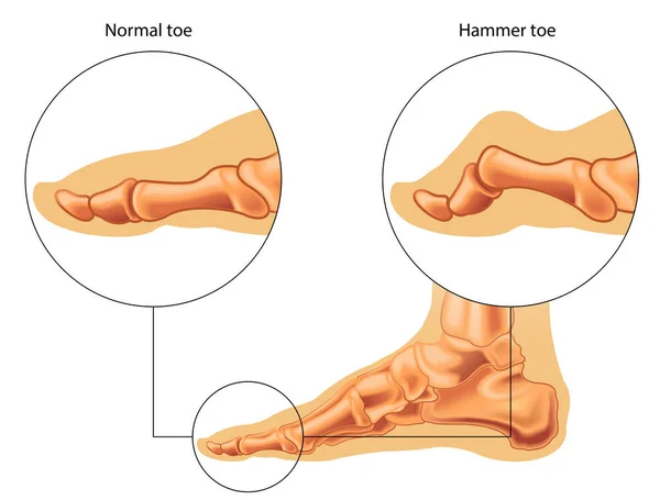 Medical Illustration Showing Hammer Toe — Stock Vector