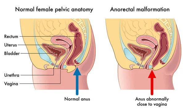 Ilustración Vector Malformación Anorrectal Femenina — Vector de stock