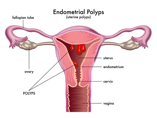 Vector Pólipos Endometriales Ilustración — Vector de stock