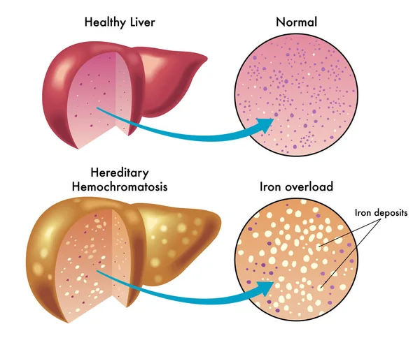 Karaciğer Hemokromatoz Vektör Çizimi — Stok Vektör