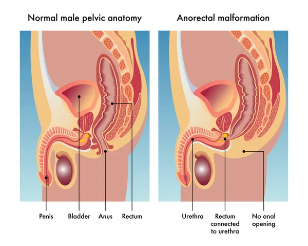 Male Anorectal Malformation Vector Illustration — Stock Vector